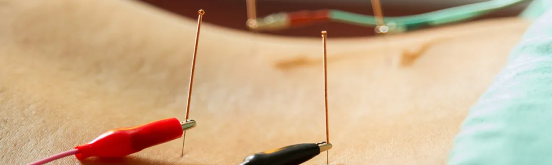 Electric acupuncture